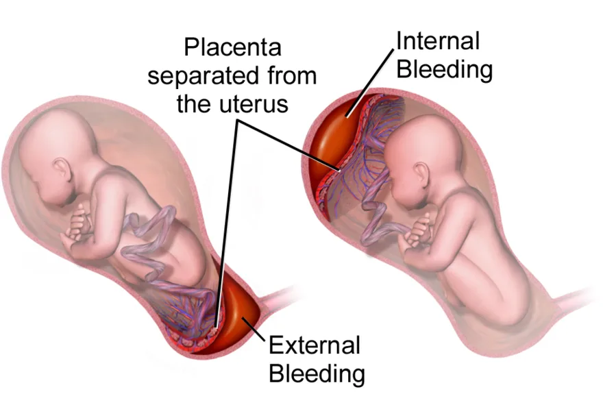 Placental abruption: the placenta separating from the uterine wall