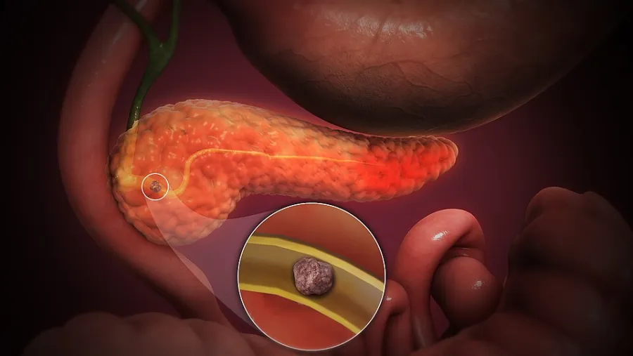 Acute Pancreatitis — clinical diagram