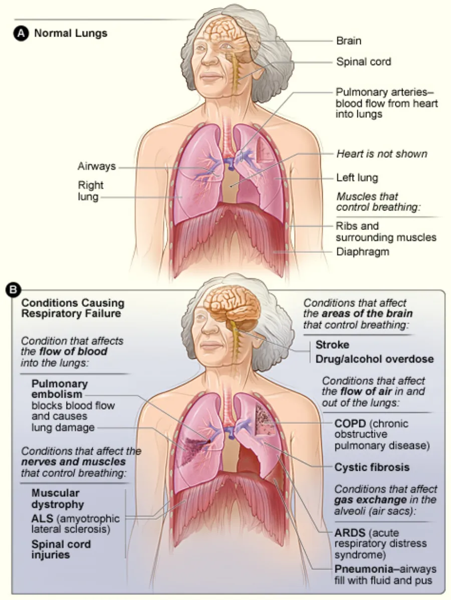 Acute Respiratory Failure — medical illustration