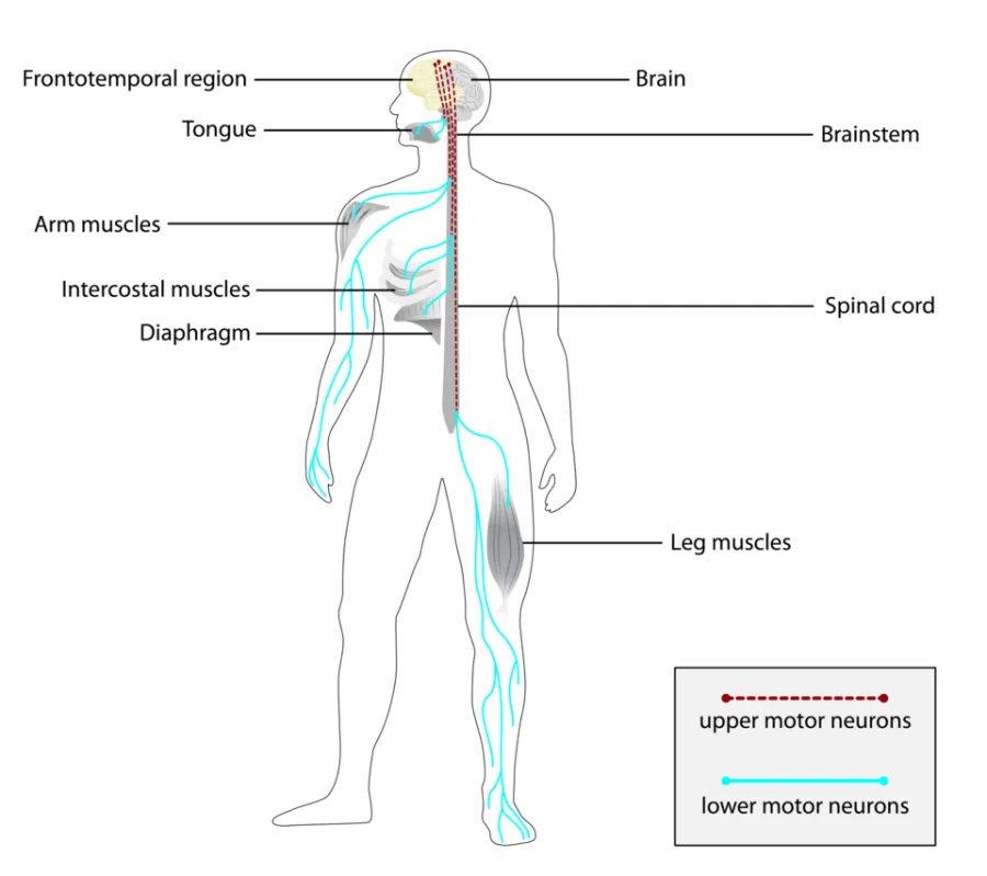 Amyotrophic Lateral Sclerosis — clinical diagram