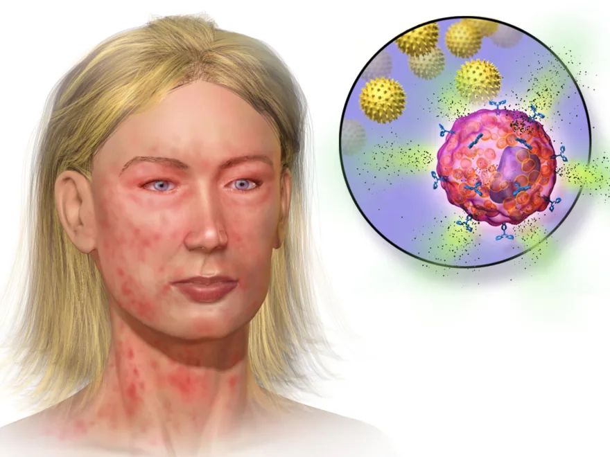 Anaphylaxis: a severe systemic allergic reaction