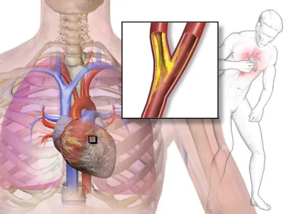 Angina: a plaque-narrowed coronary artery restricting blood flow