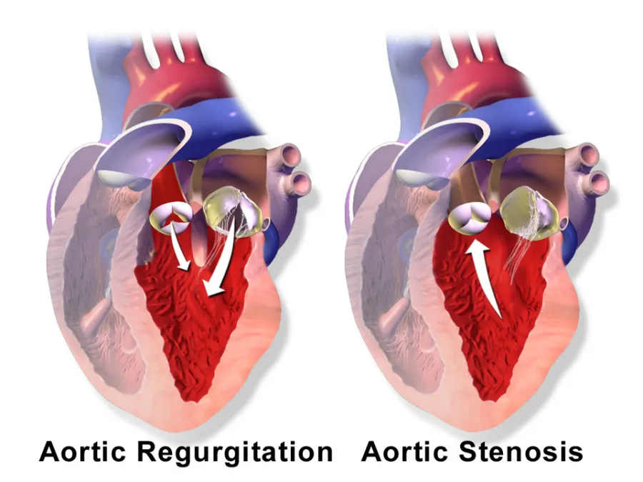 Aortic Stenosis — medical illustration