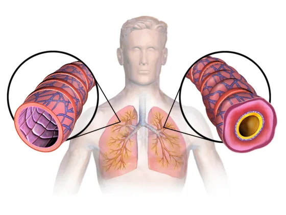 Asthma: a normal airway versus an inflamed, constricted airway
