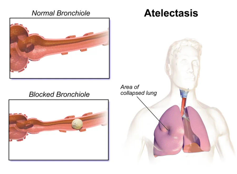 Atelectasis — medical illustration