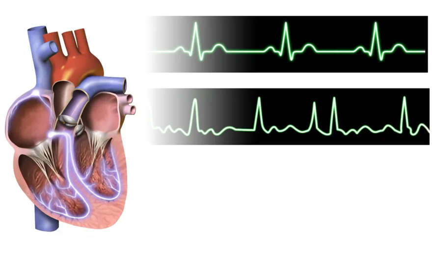 Atrial fibrillation: disorganized electrical activity in the atria