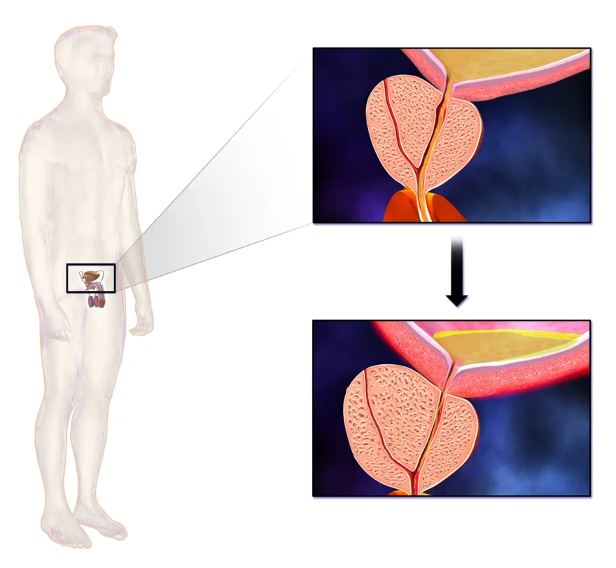 BPH: an enlarged prostate compressing the urethra
