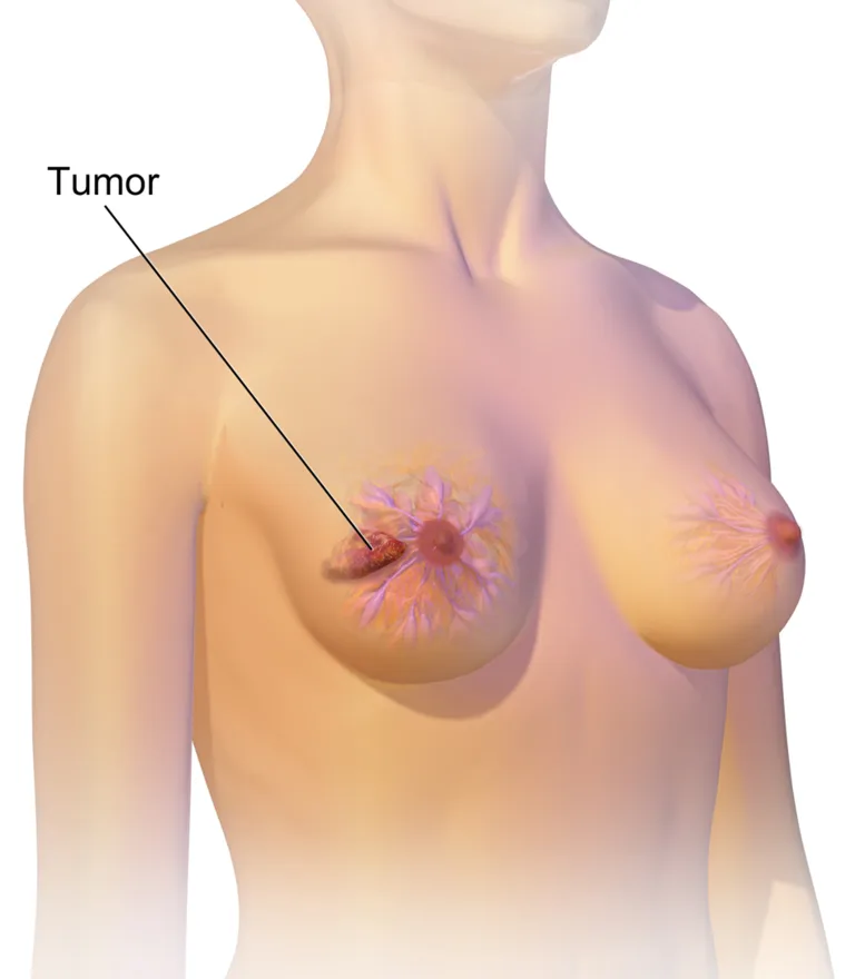 Breast cancer within the breast tissue