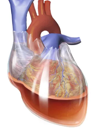 Cardiac tamponade: fluid compressing the heart in the pericardial sac