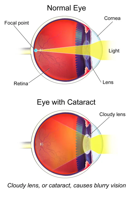 A normal eye versus an eye with a clouded cataract lens
