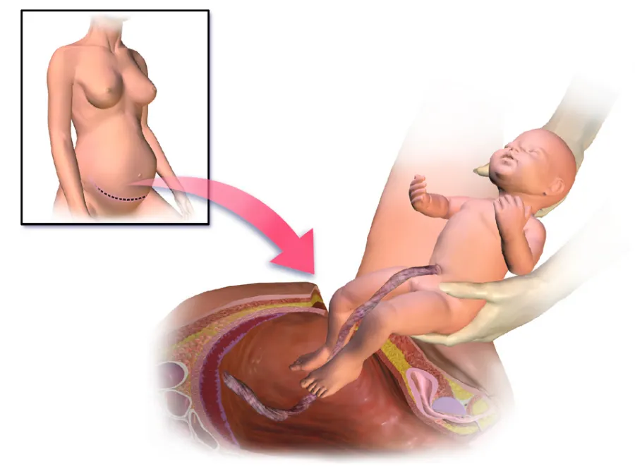 Cesarean Care — medical illustration