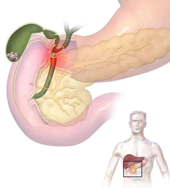 Gallstones in the gallbladder and bile duct