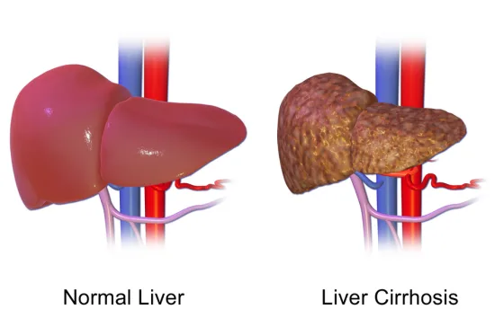 A normal liver versus a cirrhotic, scarred liver