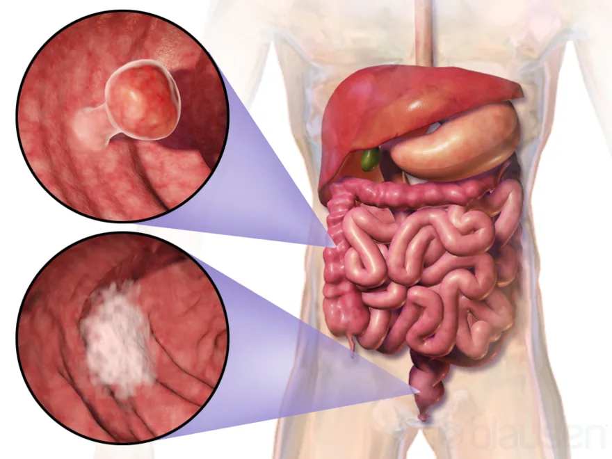 Colorectal cancer: a tumor in the wall of the colon