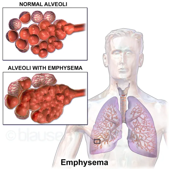 Emphysema in COPD: normal versus over-distended, damaged alveoli