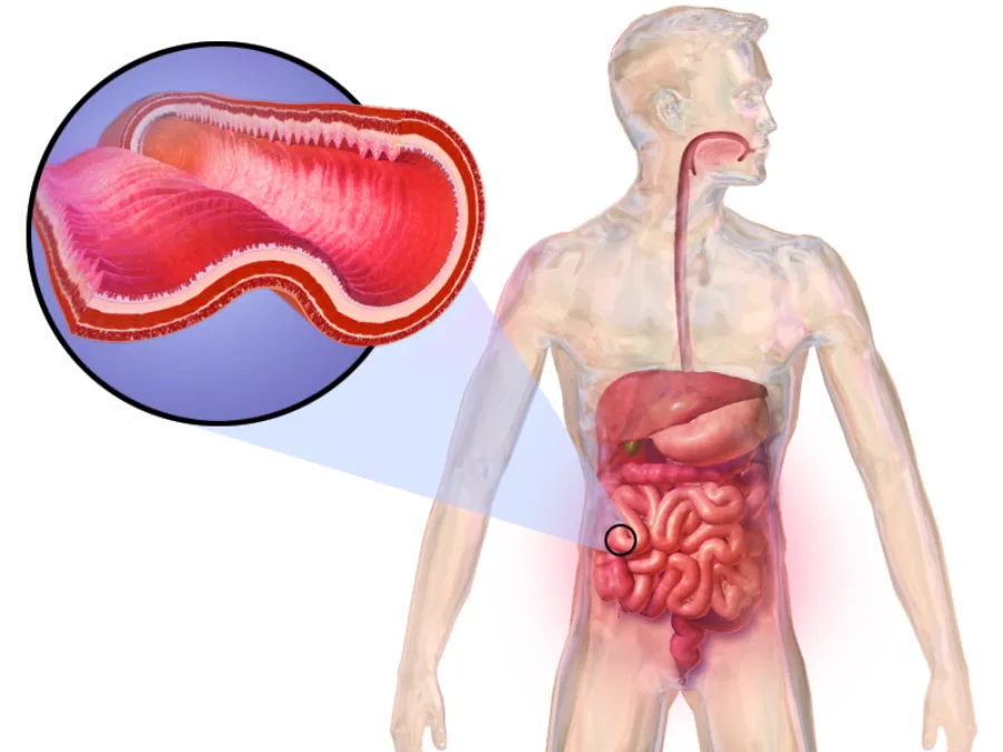 Crohn Disease — medical illustration