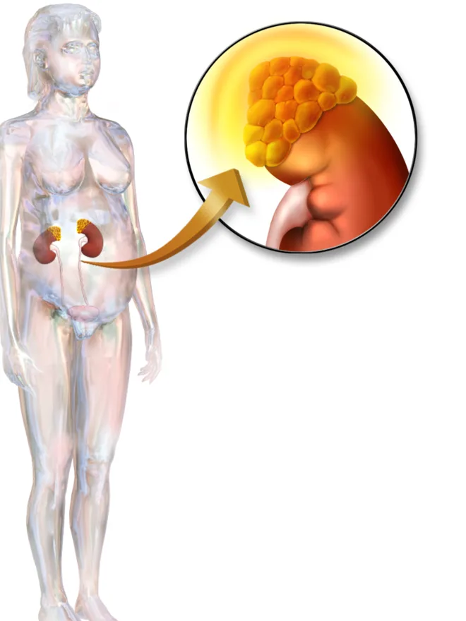 Cushing syndrome: excess cortisol from the adrenal glands