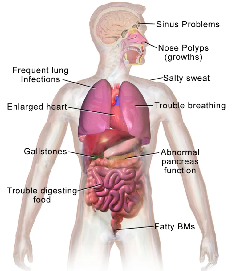 Cystic fibrosis: thick mucus clogging the airways