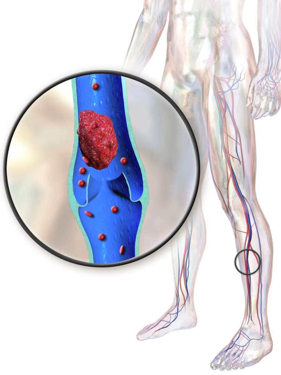Deep Vein Thrombosis Prophylaxis — medical illustration