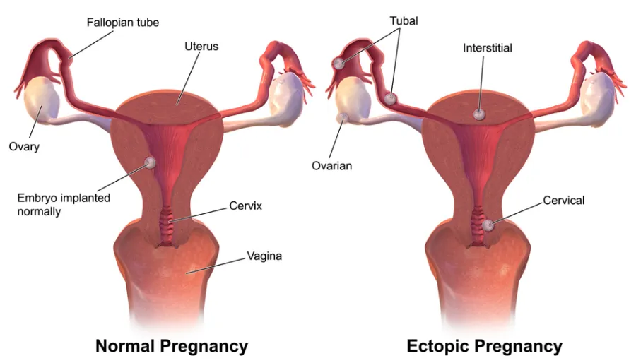 Ectopic Pregnancy — medical illustration