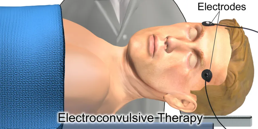Electroconvulsive Therapy — medical illustration