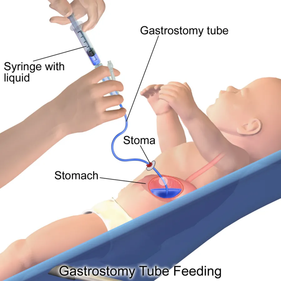 Enteral Tube Feeding — medical illustration