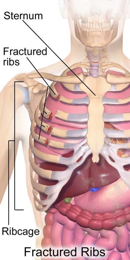 Common types of bone fracture