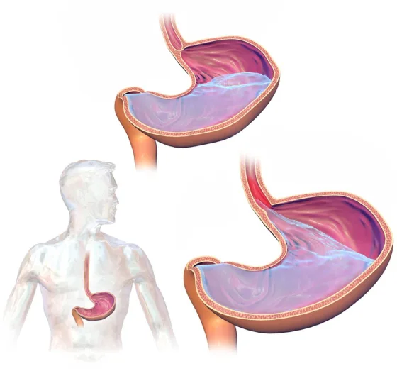 GERD: stomach acid refluxing up into the esophagus