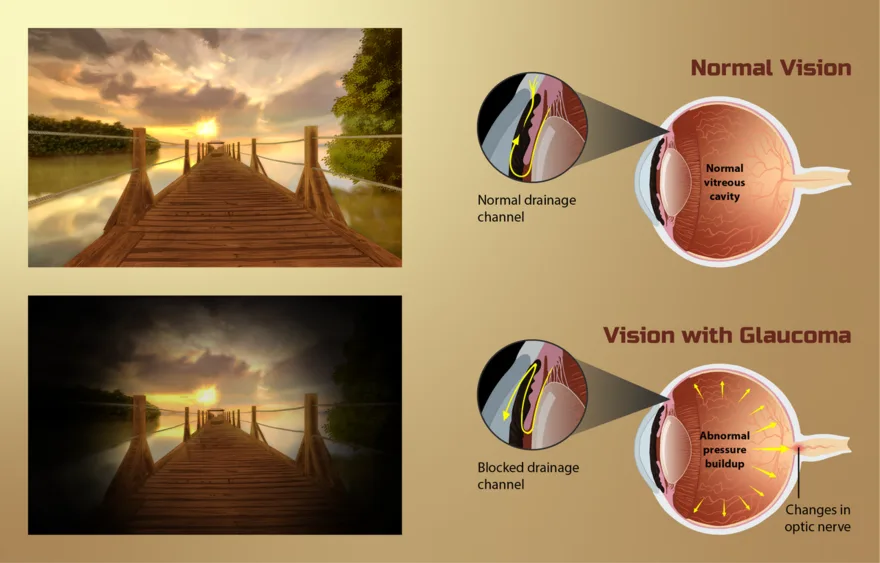 Glaucoma: raised intraocular pressure damaging the optic nerve