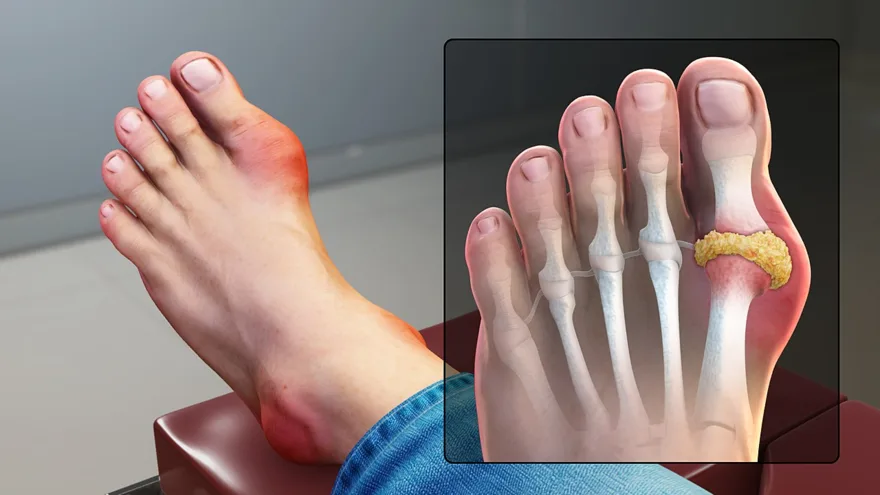 Gout: urate crystals inflaming a joint