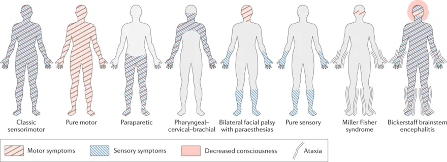 Guillain-Barré syndrome: patterns of ascending weakness
