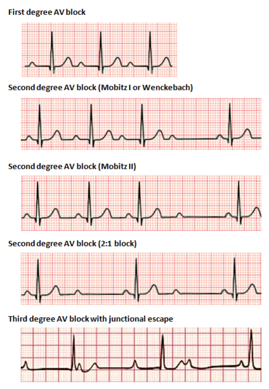Heart Blocks (AV block) — medical illustration