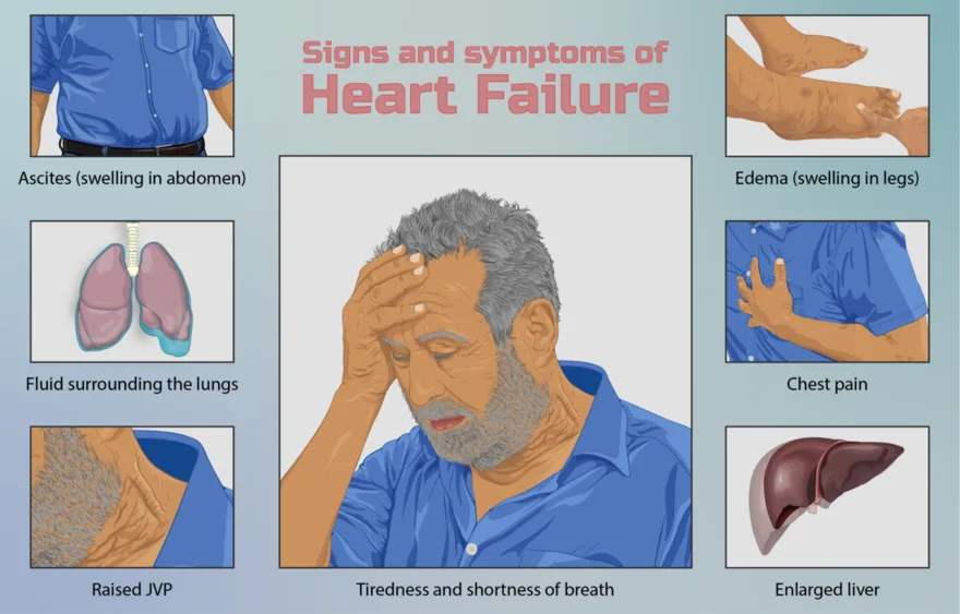 Heart failure: an enlarged, weakened heart that cannot pump effectively