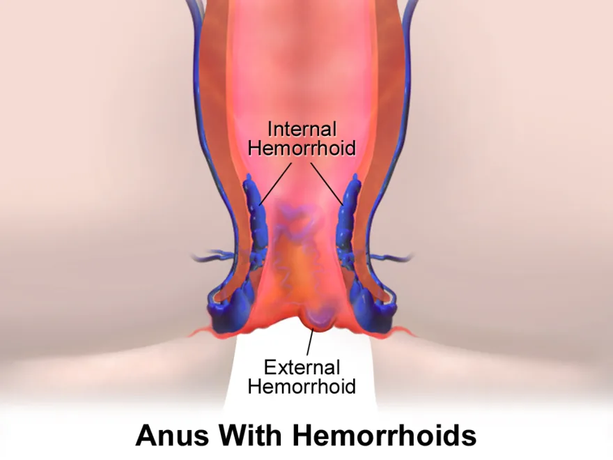 Hemorrhoids: swollen veins in the rectum and anus