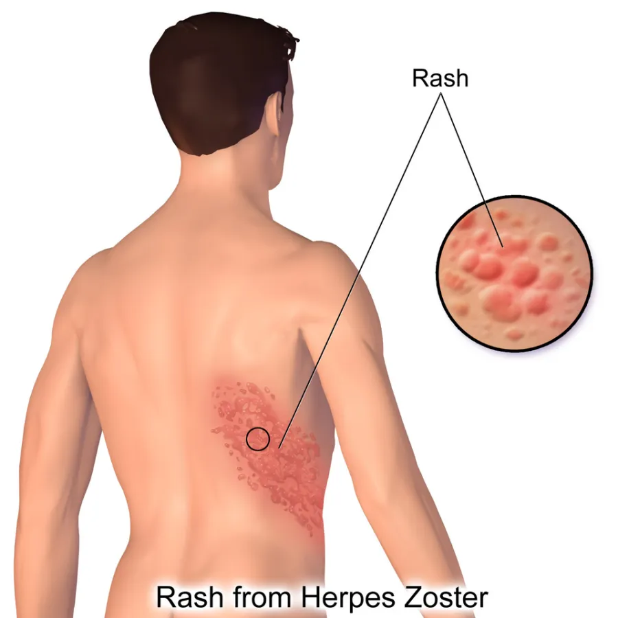 Herpes Zoster (shingles) — medical illustration