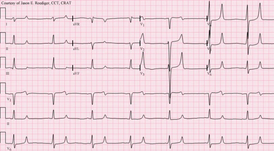 Hyperkalemia — medical illustration