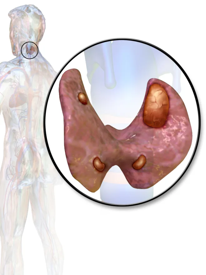 Hyperparathyroidism: a parathyroid adenoma raising calcium