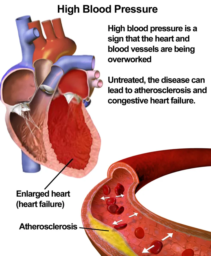 Hypertension: high pressure damaging the arterial wall