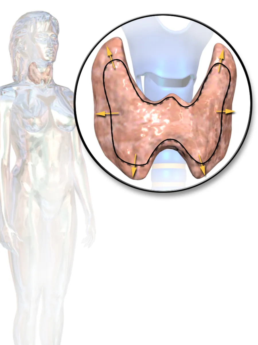 Hyperthyroidism (Graves Disease) — medical illustration