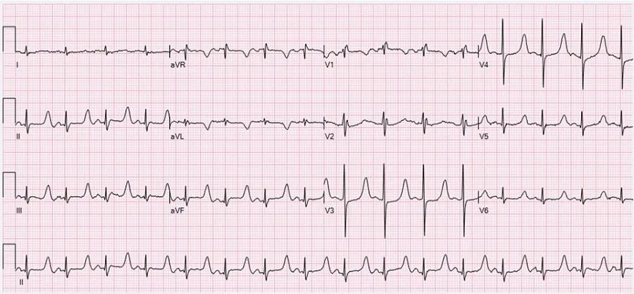 Hypocalcemia — medical illustration