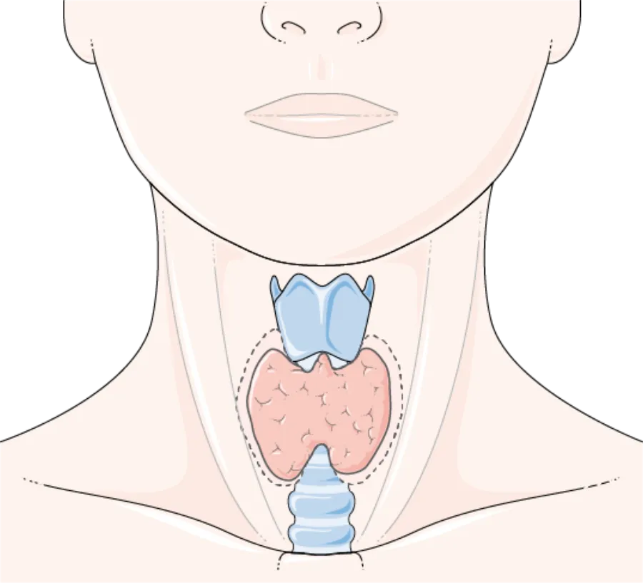 Hypothyroidism (Myxedema) — medical illustration