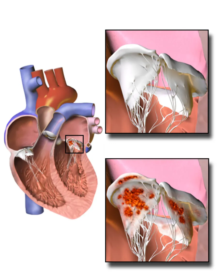 Infective Endocarditis — medical illustration