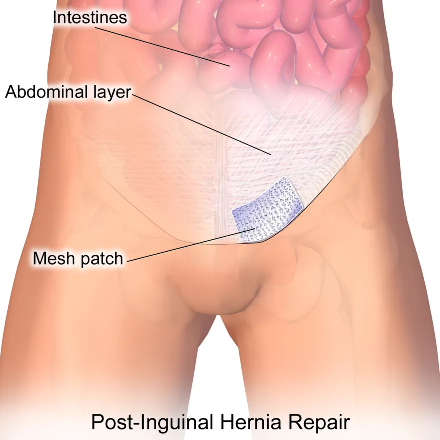 Inguinal hernia repair with a mesh patch