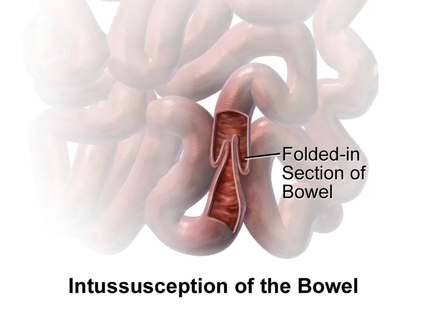 Intussusception: one segment of bowel telescoping into another