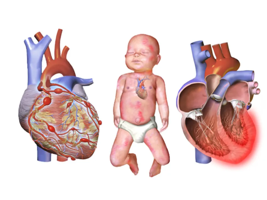 Kawasaki Disease — medical illustration