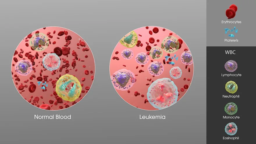 Leukemia: excess abnormal white blood cells