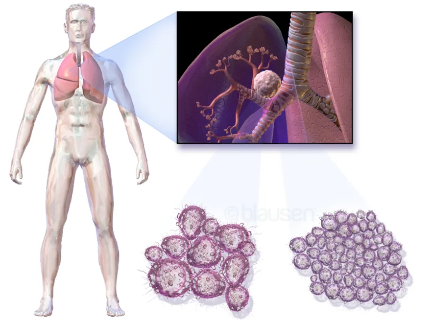 Lung cancer: a tumor within the lung
