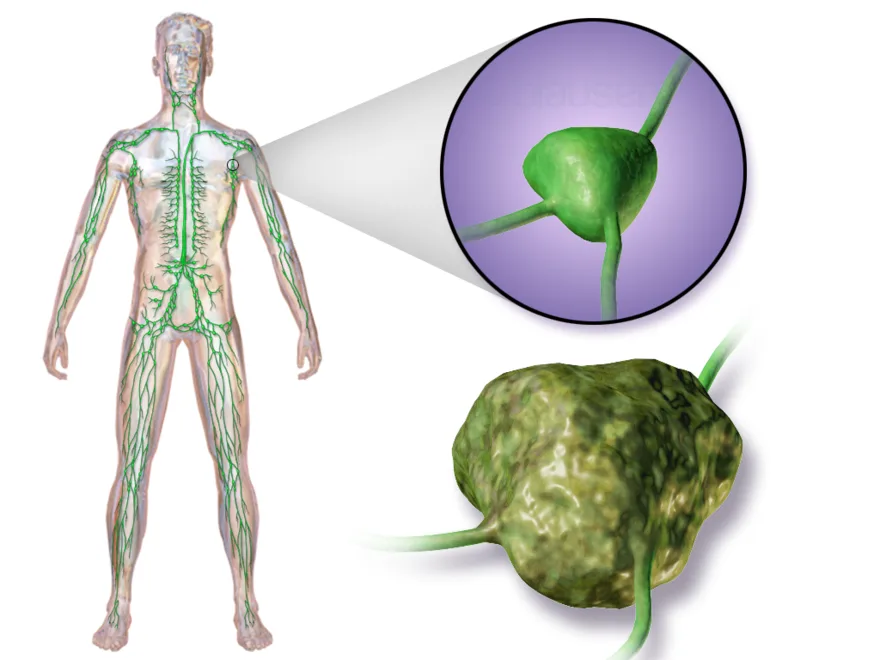 Lymphoma: cancer arising in the lymphatic system