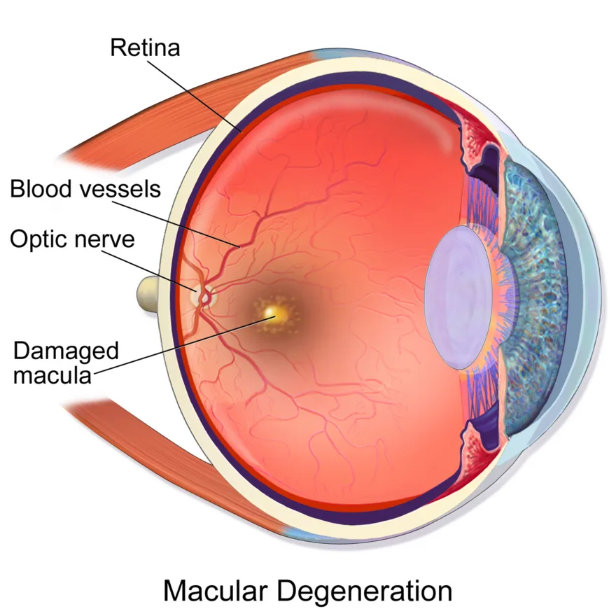Macular degeneration: damage to the macula of the retina