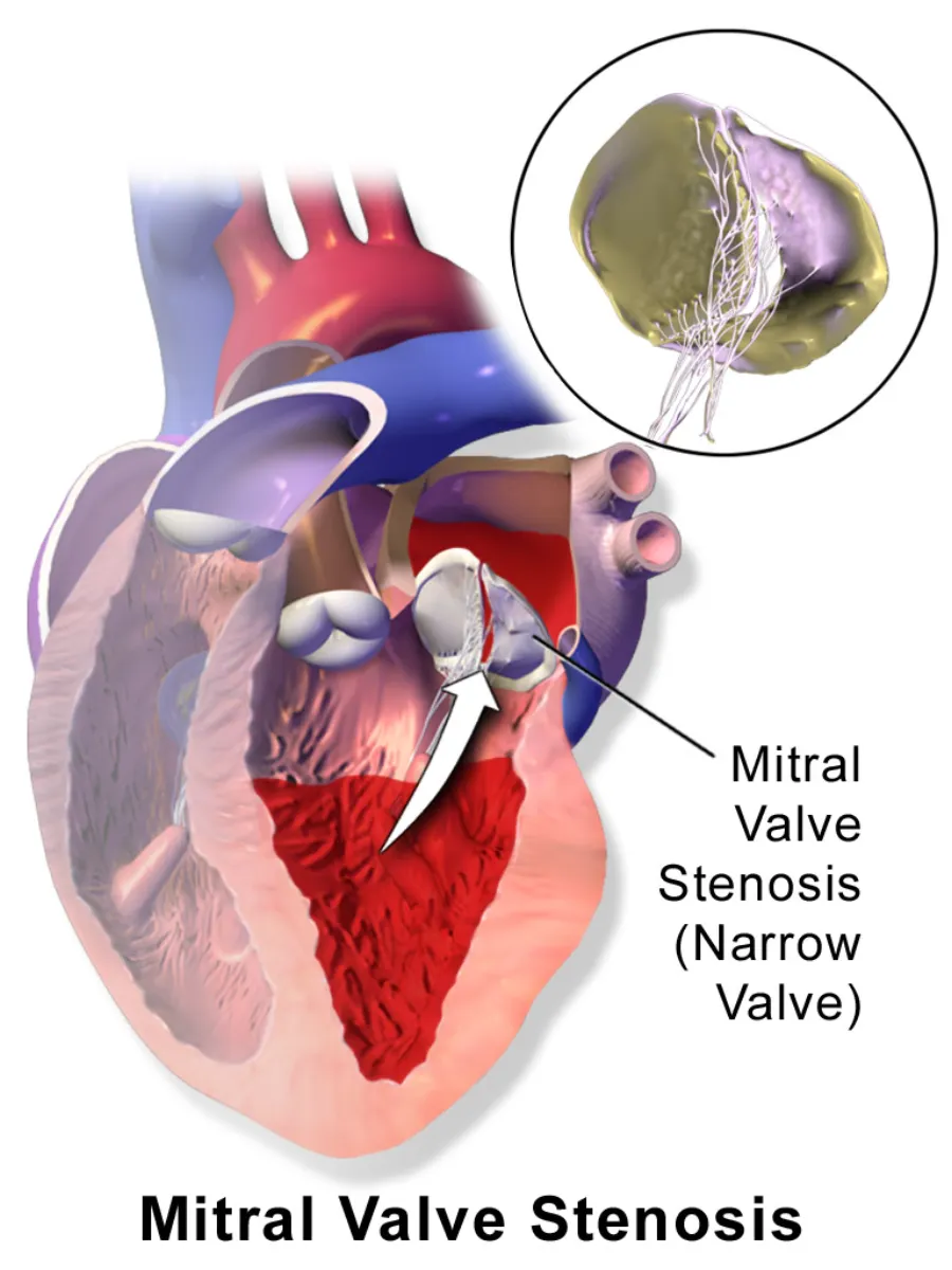 Mitral Valve Stenosis — medical illustration